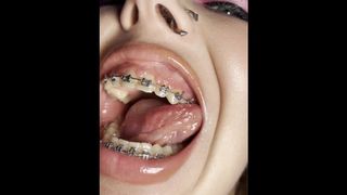Metal mouth tour. Schoolgirl with braces showing her uvula
